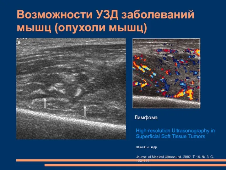 Возможности УЗД заболеваний мышц (опухоли мышц) Лимфома High-resolution Ultrasonography in