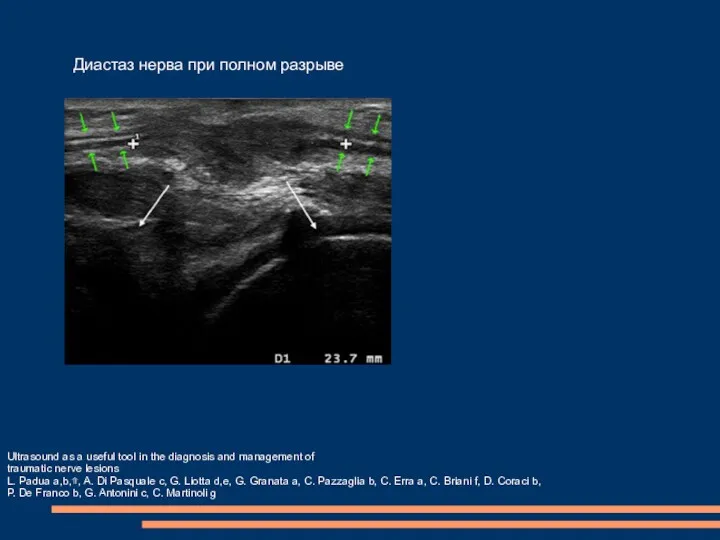 Диастаз нерва при полном разрыве Ultrasound as a useful tool