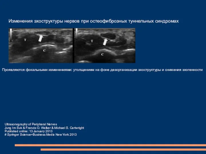 Изменения эхоструктуры нервов при остеофиброзных туннельных синдромах Проявляются фокальными изменениями: