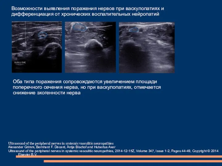 Ultrasound of the peripheral nerves in systemic vasculitic neuropathies Alexander