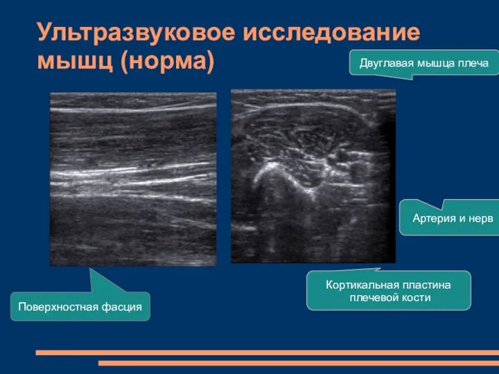 Ультразвуковое исследование мышц (норма) Артерия и нерв Кортикальная пластина плечевой кости Двуглавая мышца плеча Поверхностная фасция