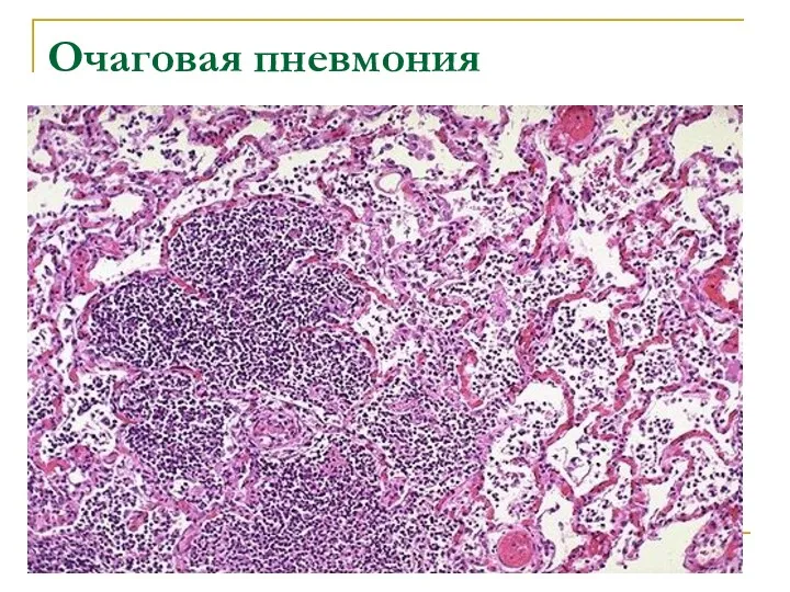 Очаговая пневмония