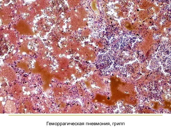 Геморрагическая пневмония, грипп