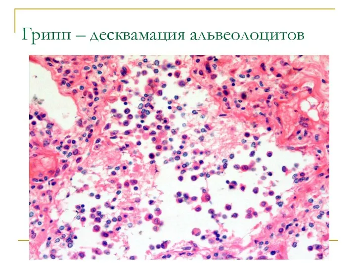 Грипп – десквамация альвеолоцитов