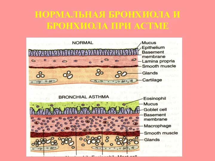 НОРМАЛЬНАЯ БРОНХИОЛА И БРОНХИОЛА ПРИ АСТМЕ