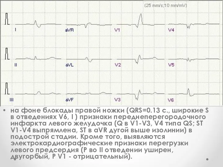 на фоне блокады правой ножки (QRS=0.13 c., широкие S в