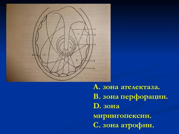 А. зона ателектаза. В. зона перфорации. D. зона мирингопексии. С. зона атрофии.