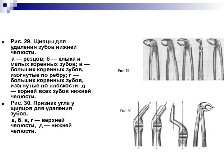 Рис. 29. Щипцы для удаления зубов нижней челюсти. а —