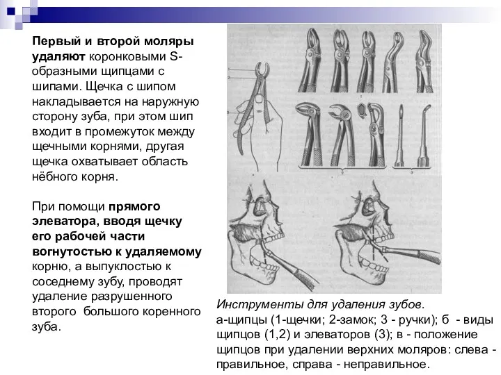 Первый и второй моляры удаляют коронковыми S- образными щипцами с