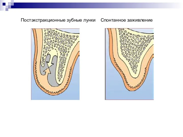Постэкстракционные зубные лунки Спонтанное заживление НКР/НРТ/Мягкая ткань