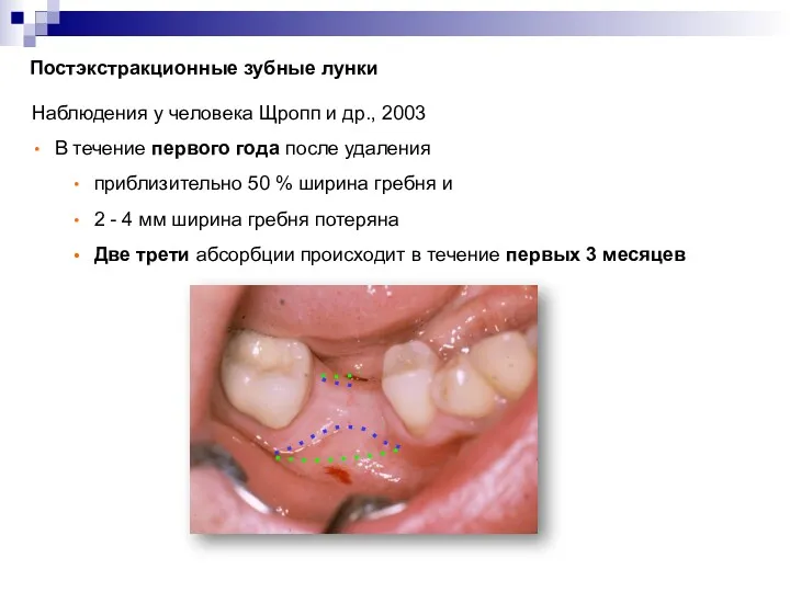 Постэкстракционные зубные лунки Коллаген Наблюдения у человека Щропп и др.,