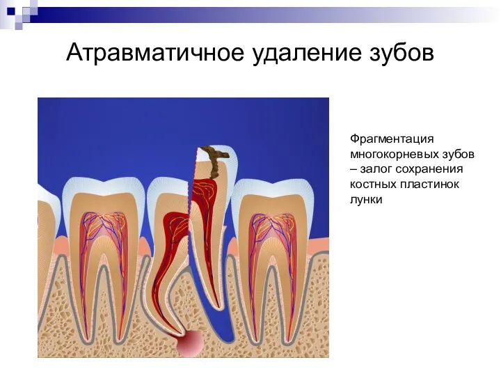 Атравматичное удаление зубов Фрагментация многокорневых зубов – залог сохранения костных пластинок лунки