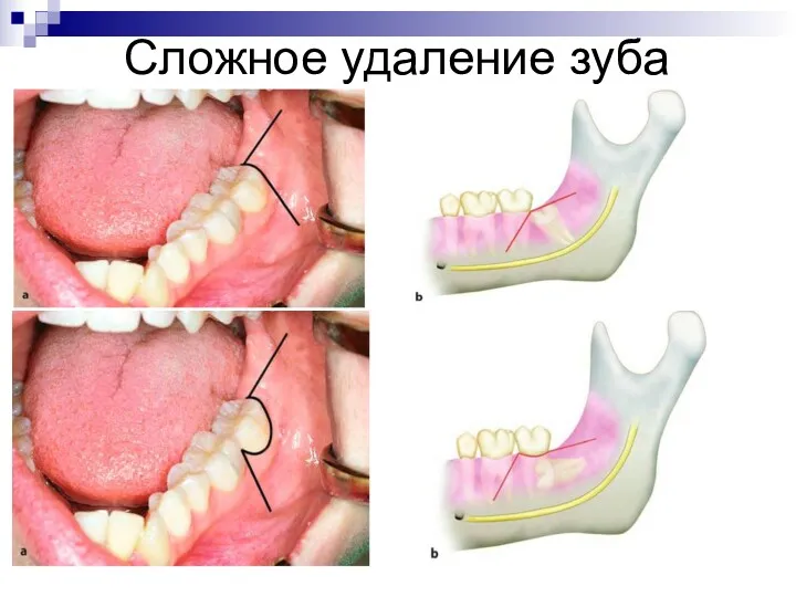 Сложное удаление зуба