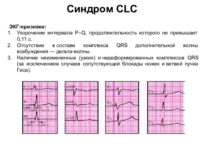 Синдром CLC ЭКГ-признаки: Укорочение интервала P–Q, продолжительность которого не превышает 0,11 с. Отсутствие