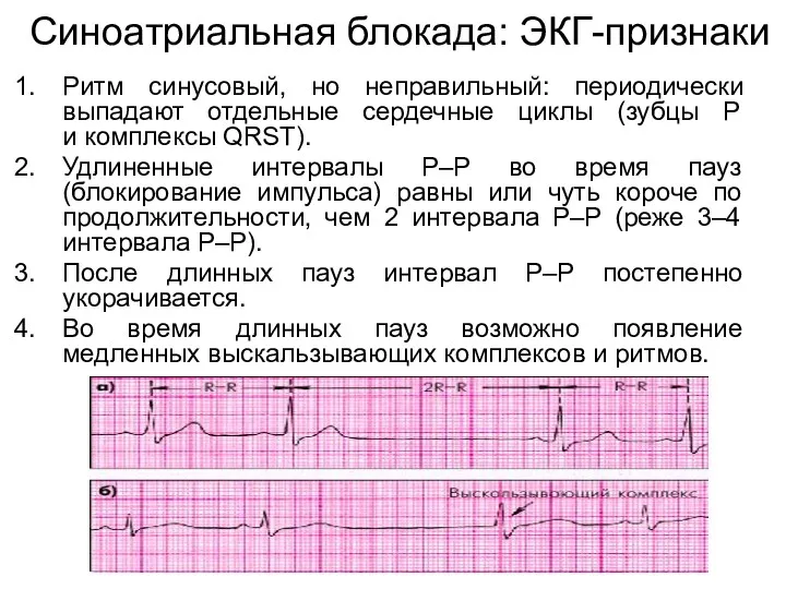Синоатриальная блокада: ЭКГ-признаки Ритм синусовый, но неправильный: периодически выпадают отдельные сердечные циклы (зубцы