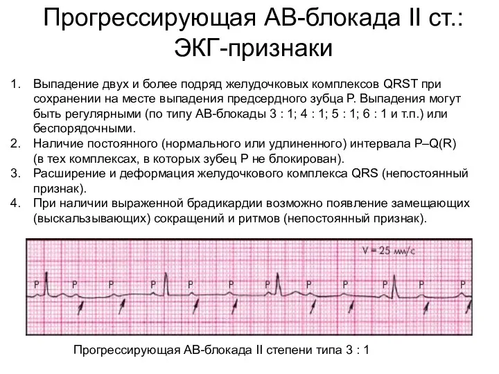 Прогрессирующая АВ-блокада II ст.: ЭКГ-признаки Выпадение двух и более подряд желудочковых комплексов QRSТ