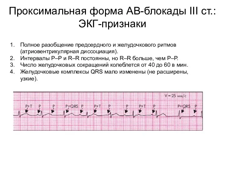 Проксимальная форма АВ-блокады III ст.: ЭКГ-признаки Полное разобщение предсердного и желудочкового ритмов (атриовентрикулярная