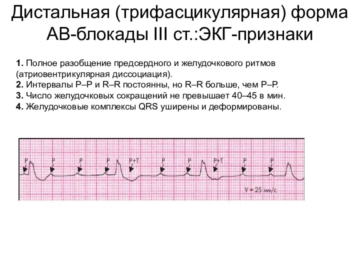 Дистальная (трифасцикулярная) форма АВ-блокады III ст.:ЭКГ-признаки 1. Полное разобщение предсердного и желудочкового ритмов