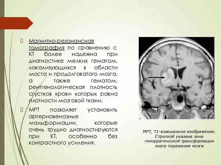 МРТ, Т1-взвешенное изображение. Стрелкой указана зона геморрагической трансформации очага поражения