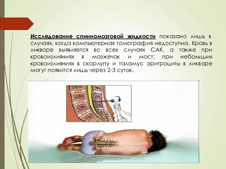 Исследование спинномозговой жидкости показано лишь в случаях, когда компьютерная томография