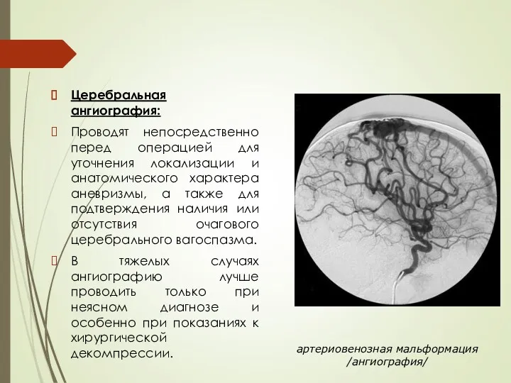 артериовенозная мальформация /ангиография/ Церебральная ангиография: Проводят непосредственно перед операцией для