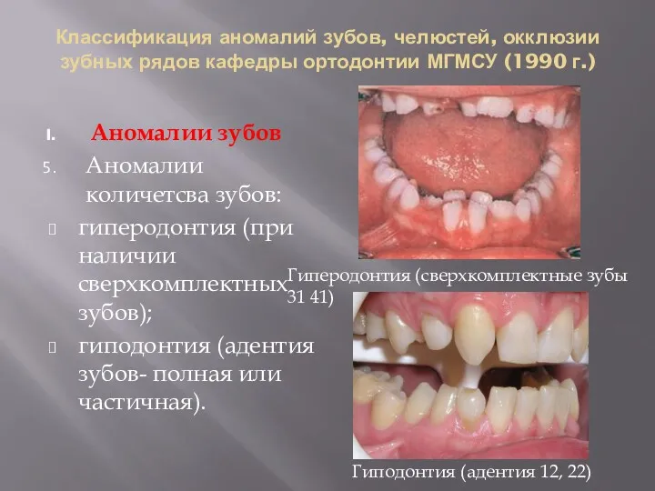 Классификация аномалий зубов, челюстей, окклюзии зубных рядов кафедры ортодонтии МГМСУ (1990 г.) Аномалии