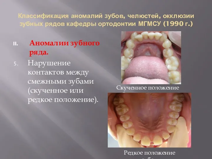 Классификация аномалий зубов, челюстей, окклюзии зубных рядов кафедры ортодонтии МГМСУ (1990 г.) Аномалии