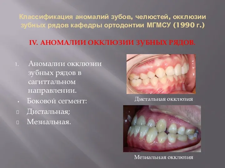 Классификация аномалий зубов, челюстей, окклюзии зубных рядов кафедры ортодонтии МГМСУ (1990 г.) IV.