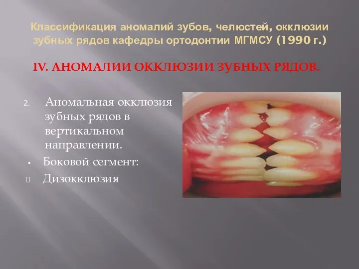 Классификация аномалий зубов, челюстей, окклюзии зубных рядов кафедры ортодонтии МГМСУ (1990 г.) IV.