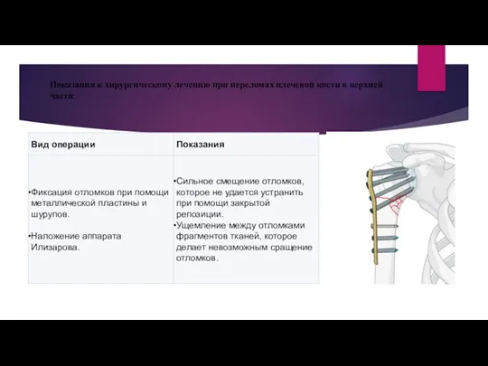 Показания к хирургическому лечению при переломах плечевой кости в верхней части: