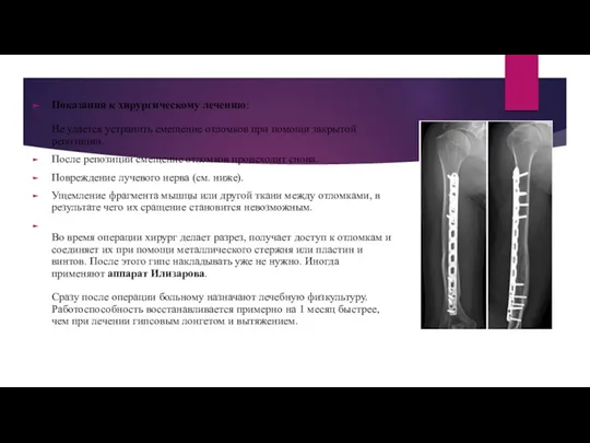 Показания к хирургическому лечению: Не удается устранить смещение отломков при