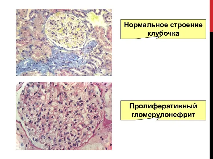 Нормальное строение клубочка Пролиферативный гломерулонефрит