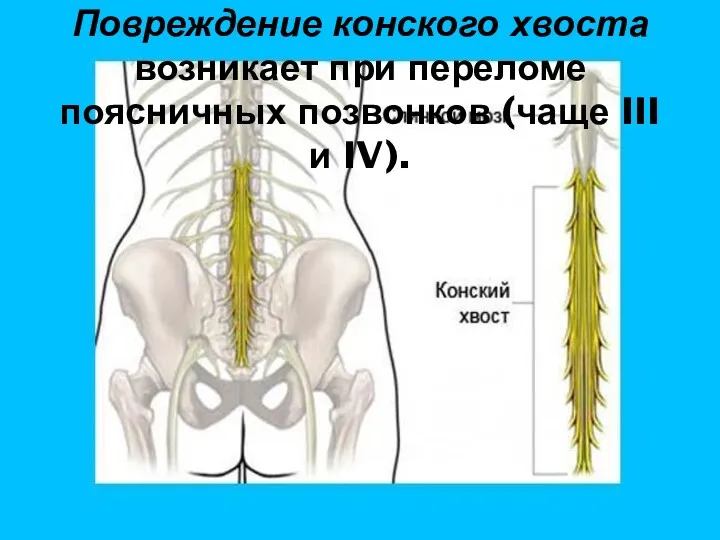 Повреждение конского хвоста возникает при переломе поясничных позвонков (чаще III и IV).