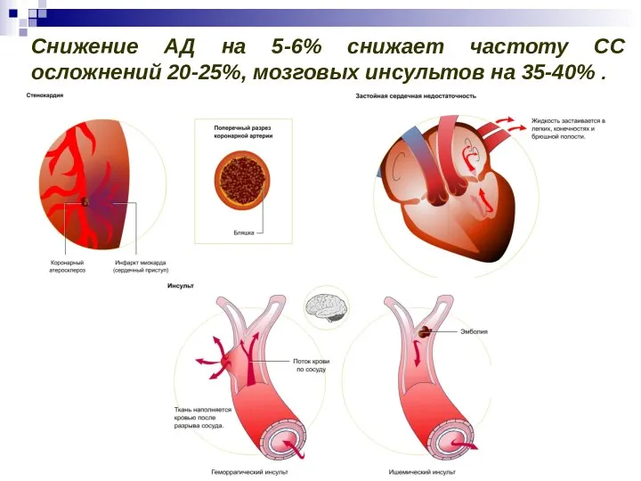 Снижение АД на 5-6% снижает частоту СС осложнений 20-25%, мозговых инсультов на 35-40% .