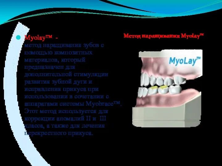 Myolay™ - метод наращивания зубов с помощью композитных материалов, который