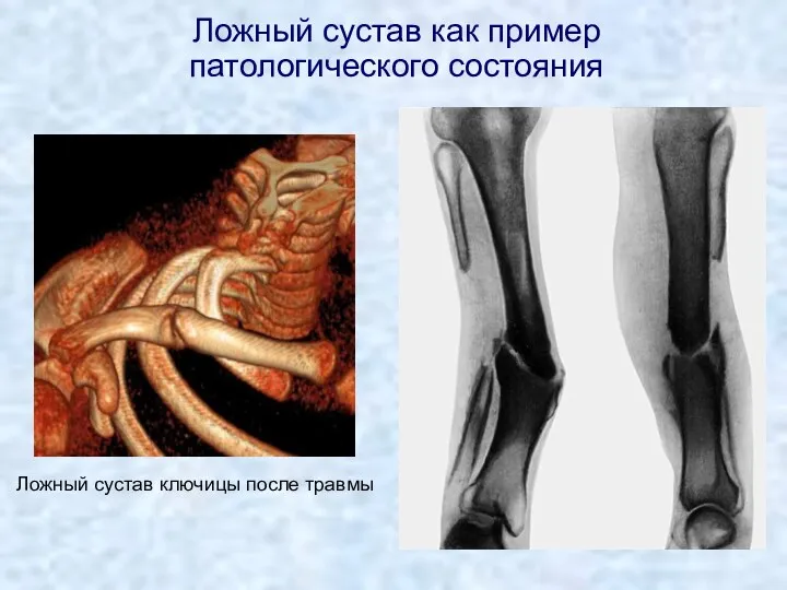 Ложный сустав ключицы после травмы Ложный сустав как пример патологического состояния