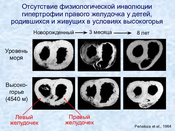 Отсутствие физиологической инволюции гипертрофии правого желудочка у детей, родившихся и