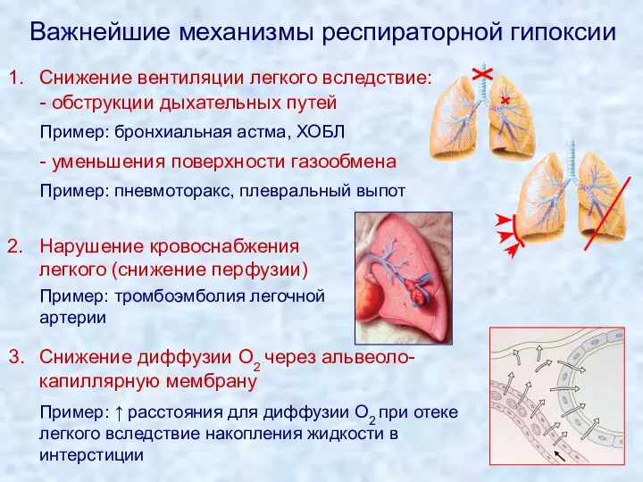 Важнейшие механизмы респираторной гипоксии Снижение диффузии O2 через альвеоло-капиллярную мембрану