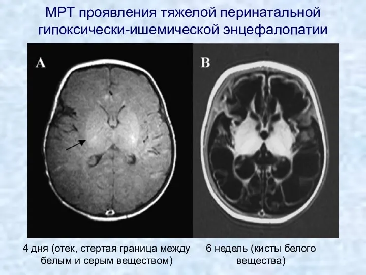 МРТ проявления тяжелой перинатальной гипоксически-ишемической энцефалопатии 4 дня (отек, стертая