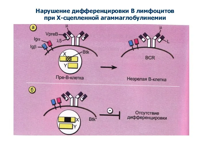Нарушение дифференцировки В лимфоцитов при Х-сцепленной агаммаглобулинемии