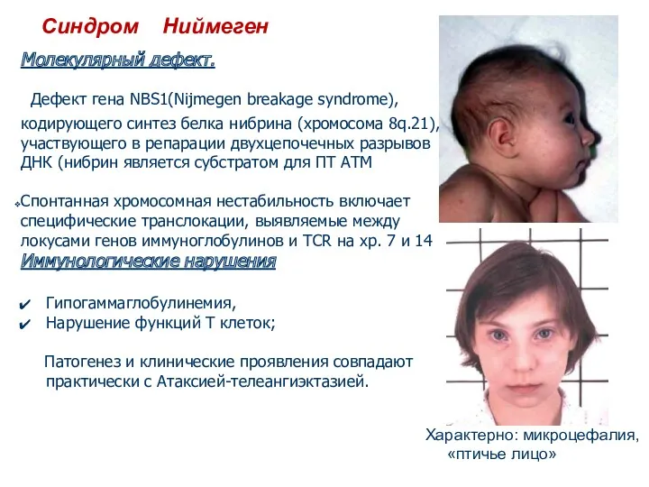 Синдром Ниймеген Молекулярный дефект. Дефект гена NBS1(Nijmegen breakage syndrome), кодирующего