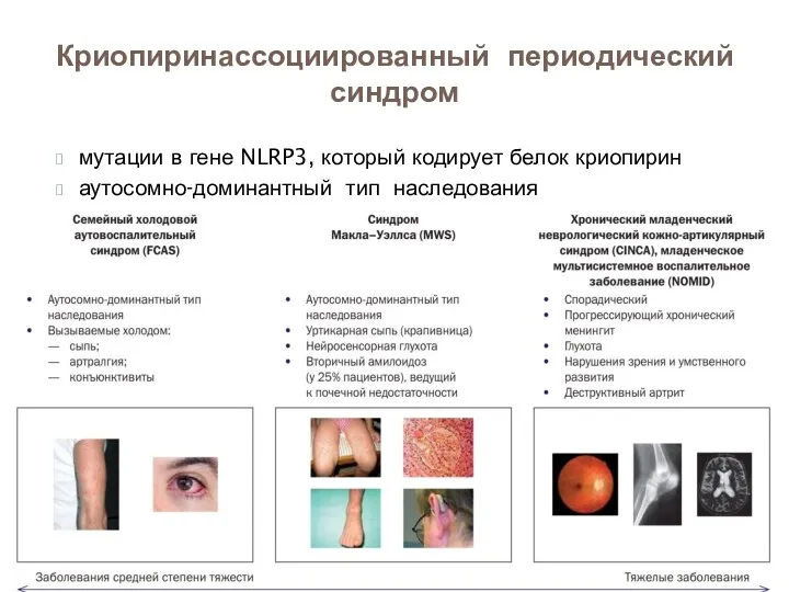 мутации в гене NLRP3, который кодирует белок криопирин аутосомно-доминантный тип наследования Криопиринассоциированный периодический синдром