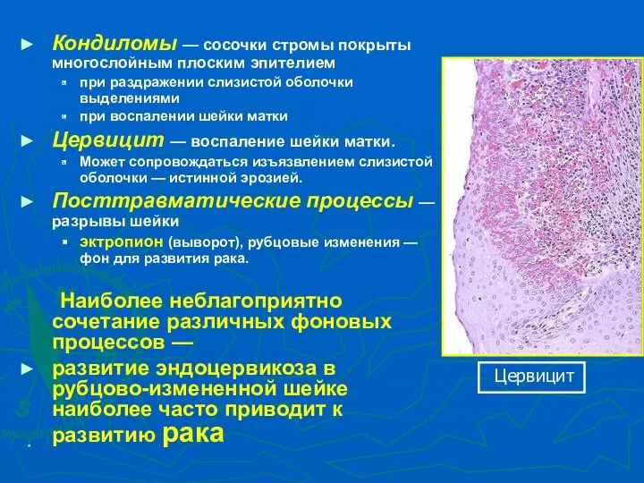 * Кондиломы — сосочки стромы покрыты многослойным плоским эпителием при