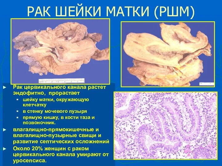 * РАК ШЕЙКИ МАТКИ (РШМ) Рак цервикального канала растет эндофитно,