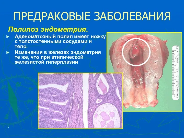 * ПРЕДРАКОВЫЕ ЗАБОЛЕВАНИЯ Полипоз эндометрия. Аденоматозный полип имеет ножку с