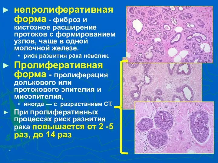 * непролиферативная форма - фиброз и кистозное расширение протоков с