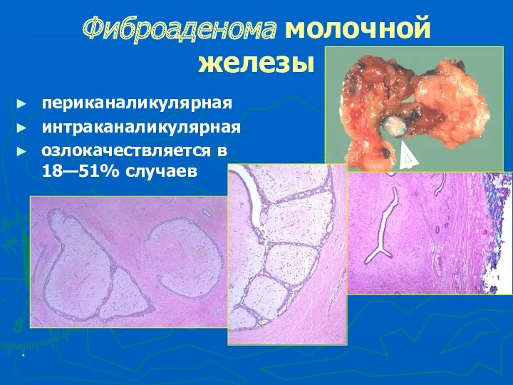 * Фиброаденома молочной железы периканаликулярная интраканаликулярная озлокачествляется в 18—51% случаев