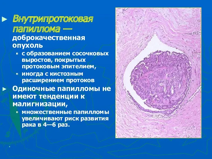 * Внутрипротоковая папиллома — доброкачественная опухоль с образованием сосочковых выростов,