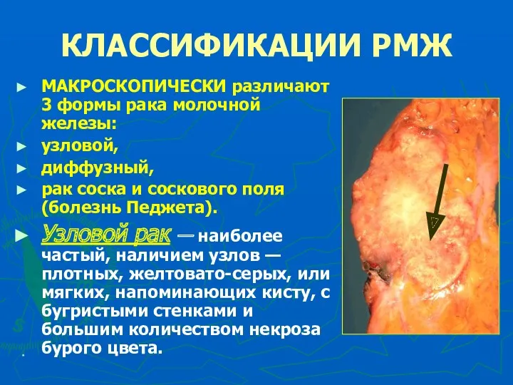 * КЛАССИФИКАЦИИ РМЖ МАКРОСКОПИЧЕСКИ различают 3 формы рака молочной железы: