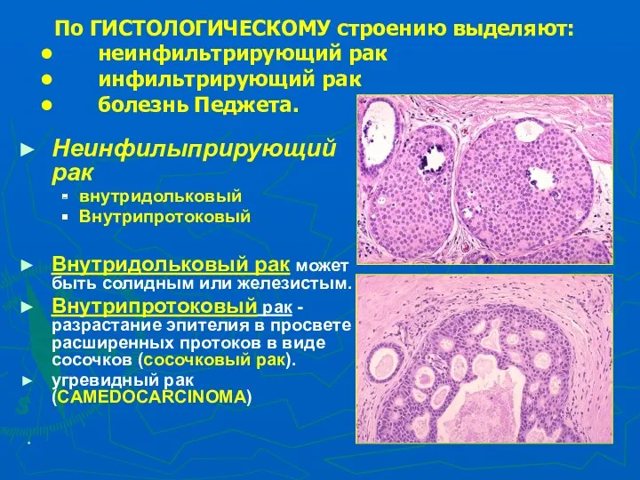 * Неинфилыприрующий рак внутридольковый Внутрипротоковый Внутридольковый рак может быть солидным